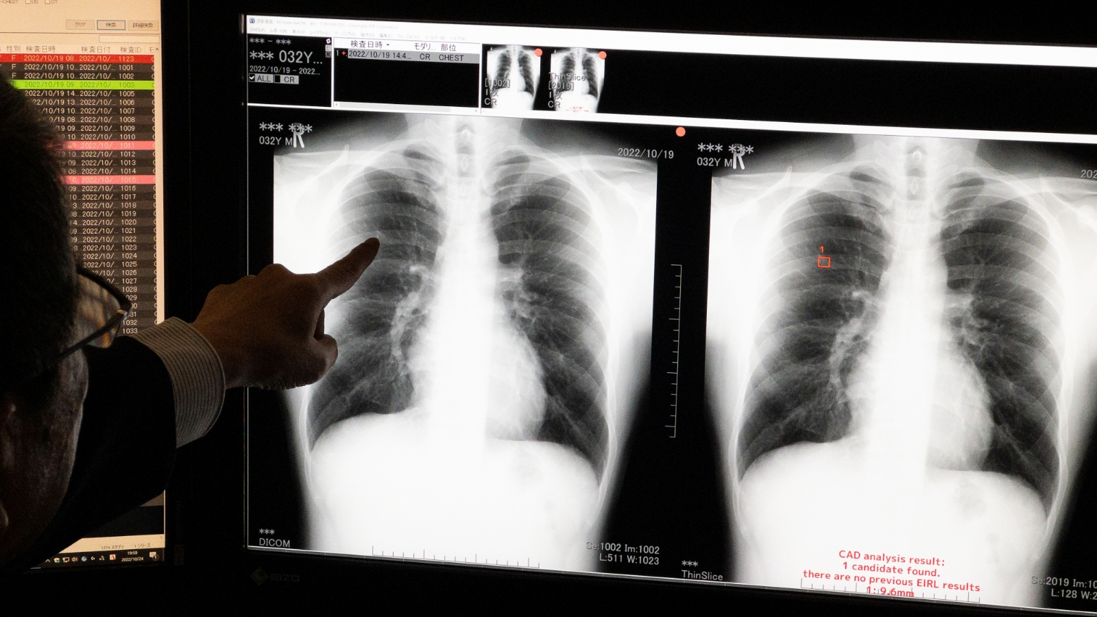 AIの支援を受けながら胸部のX線画像を読影